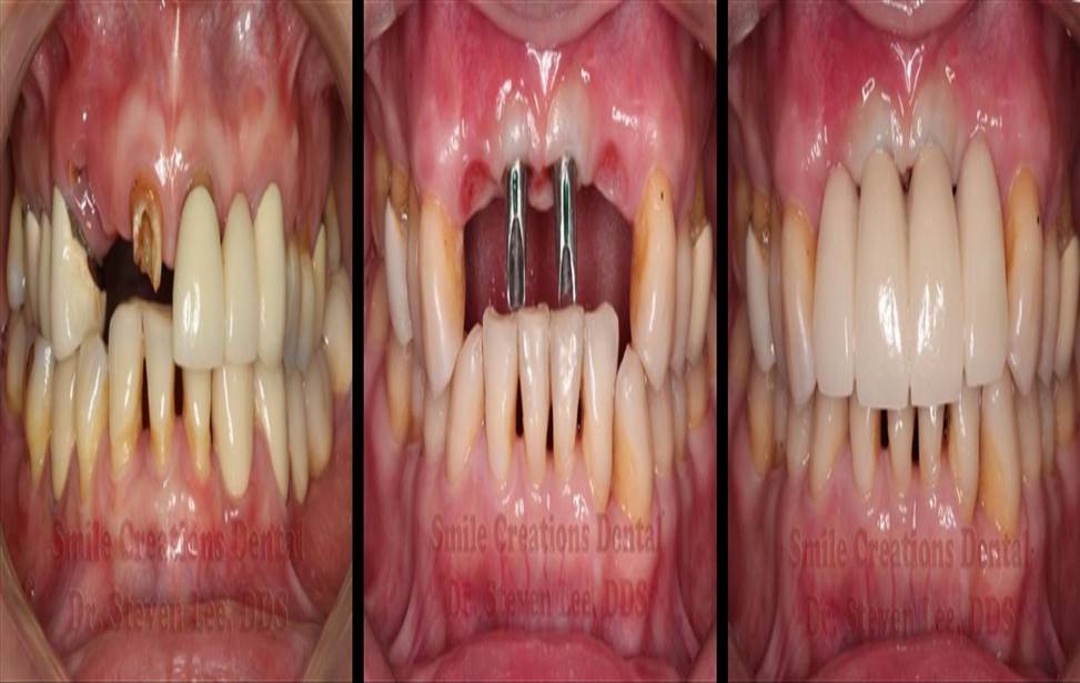 ​ایمپلنت های دندانی