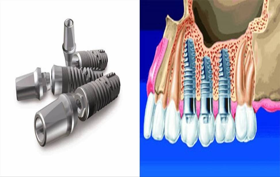 ​ایمپلنت های دندانی