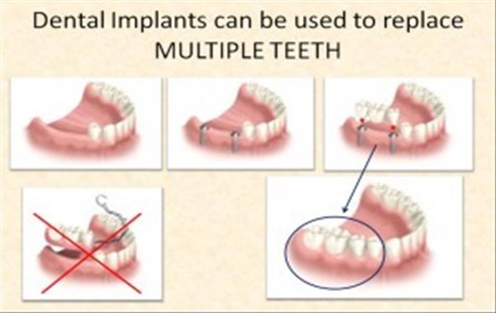 ​ایمپلنت های دندانی
