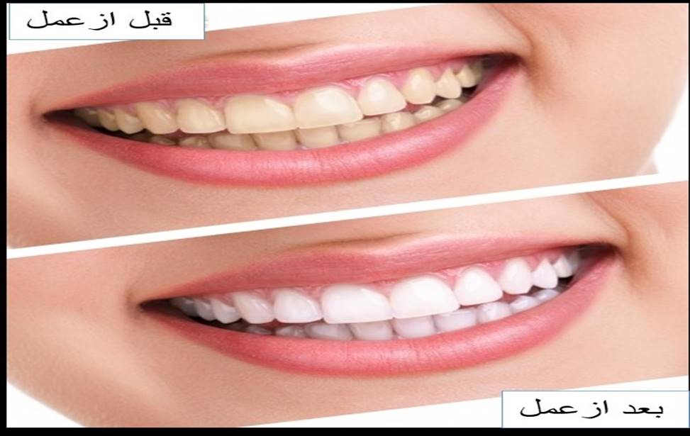 دندانپزشکی زیبایی و طراحی لبخند